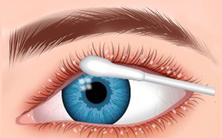 Dry Eyes Are Both A Cause And An Effect Of Blepharitis. 